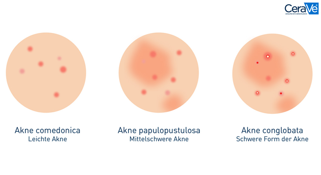 Grafik mit unterschiedlichen Schweregraden der Akne